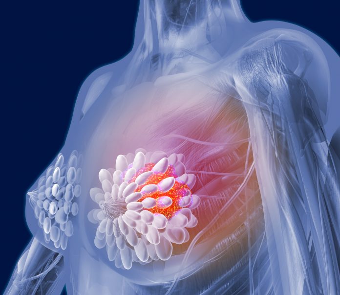 107254377 Imagen translúcida del torso de una mujer que muestra cáncer de mama en un seno. Tomar terapia de reemplazo hormonal (TRH) durante la menopausia no aumenta el riesgo de cáncer de mama en mujeres con mutaciones genéticas BRCA1 o BRCA2 asociadas al cáncer.