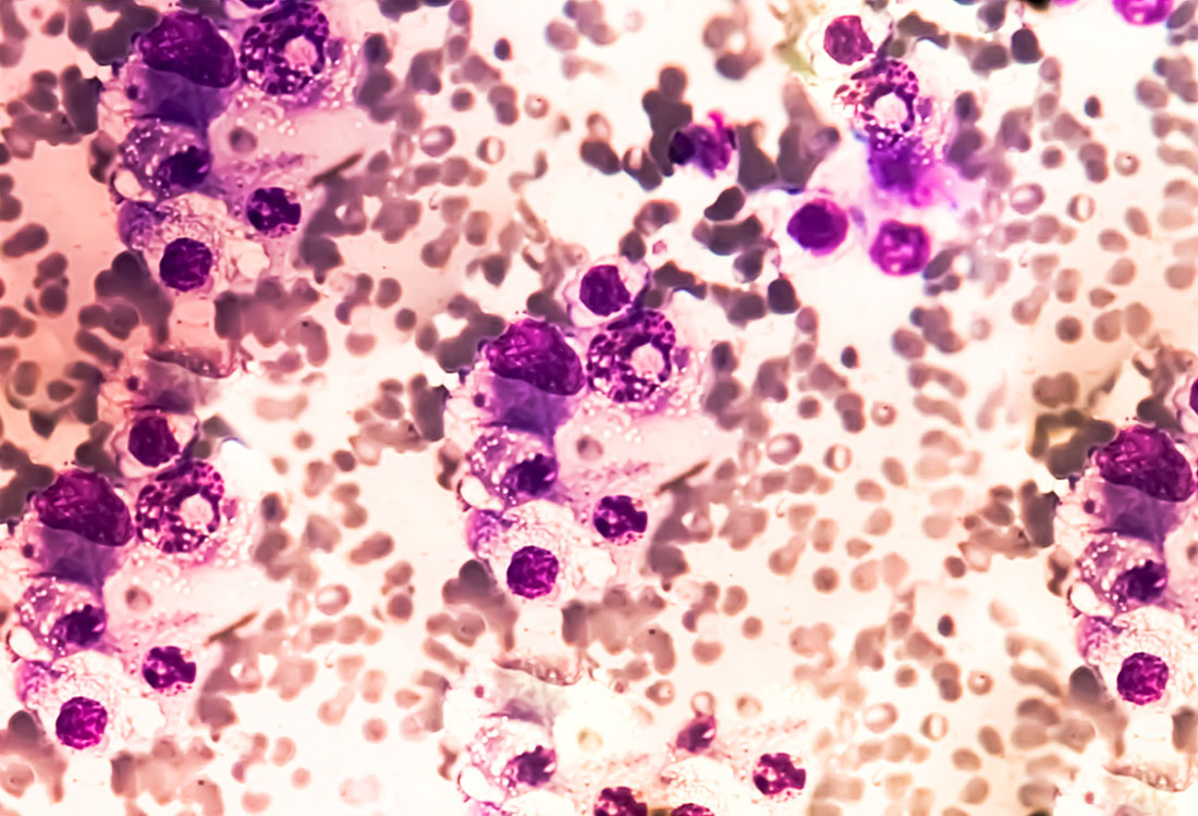Mieloma múltiple, las células plasmáticas cancerosas se acumulan en la médula ósea. Imagen microscópica de la concepción hematológica.